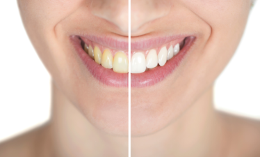 Бережное отбеливание зубов: методы и советы
